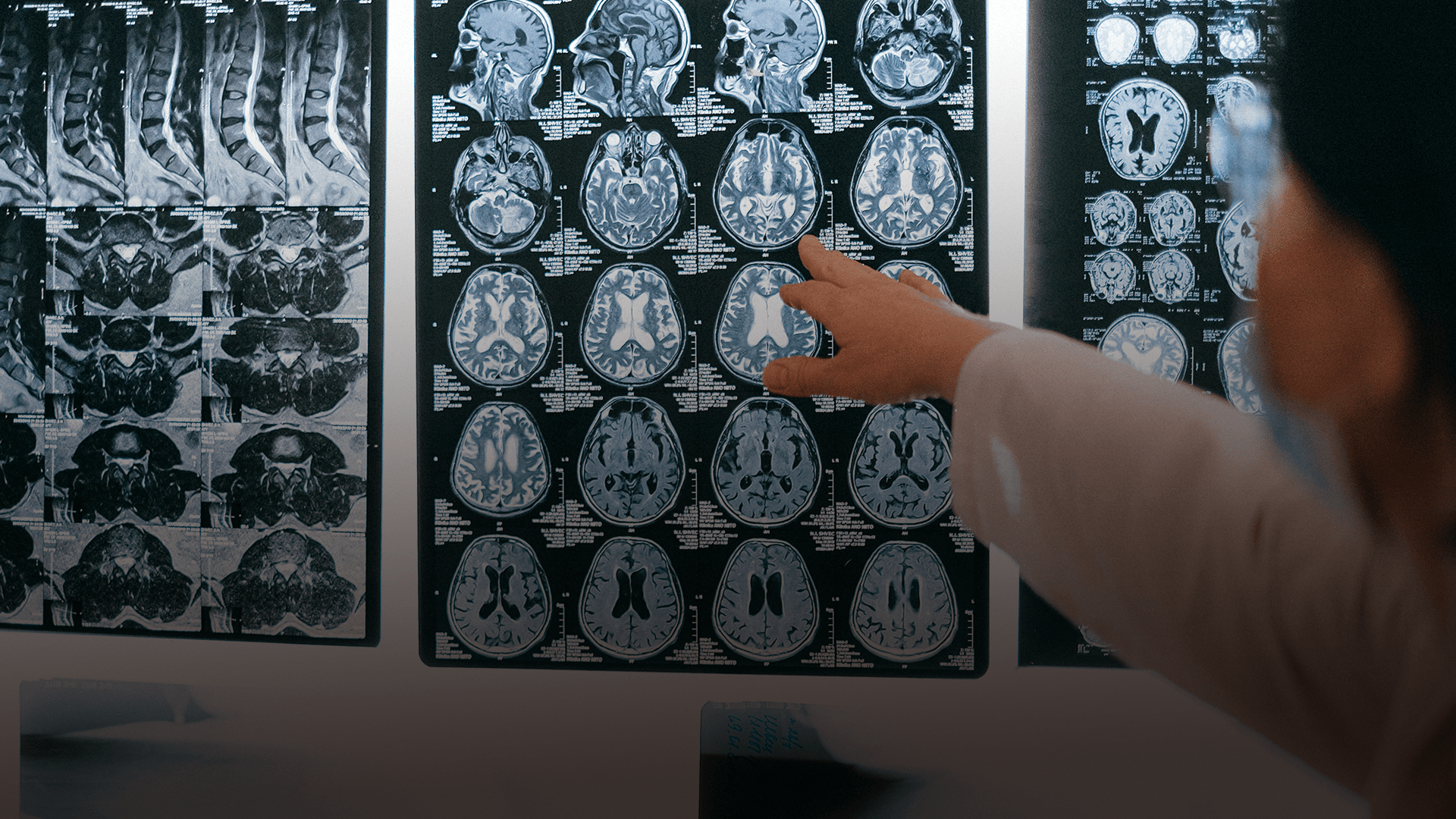 A doctor closely examining a set of MRI brain scans displayed on a lightbox.