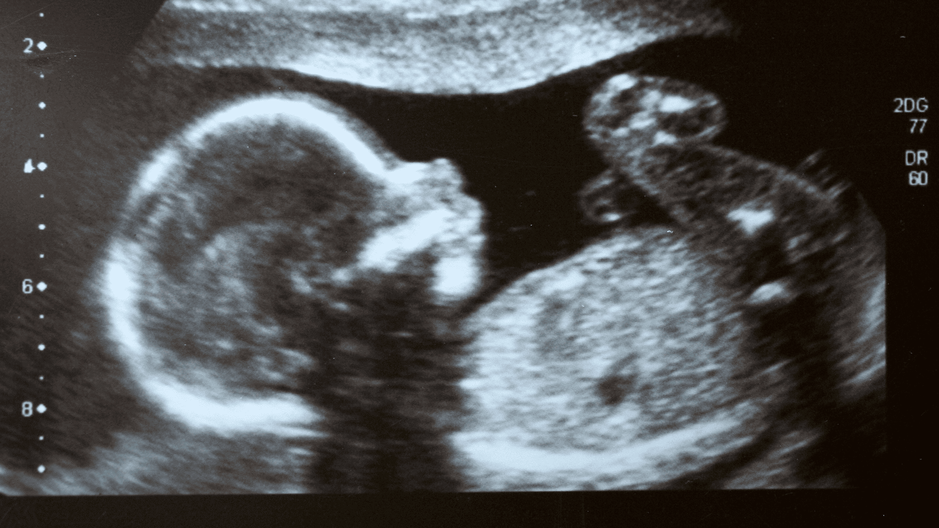 Foetus ultrasound