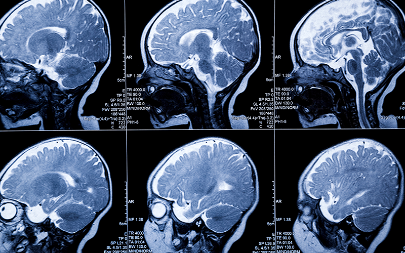 1 year baby MRI scan