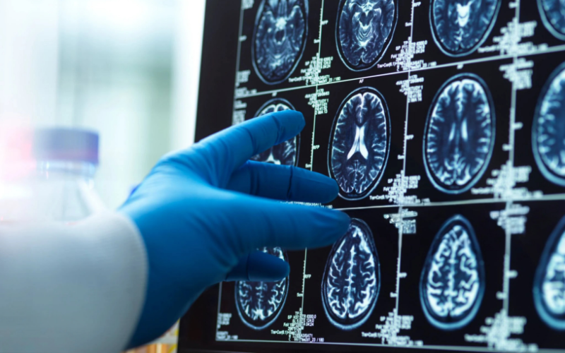 A doctor's hand in a surgical glove pointing at a brain scan image on a computer screen